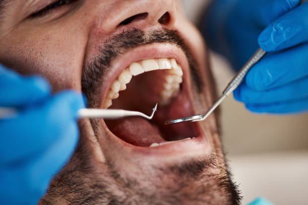 Best Emergency Tooth Extraction in Mccord, OK